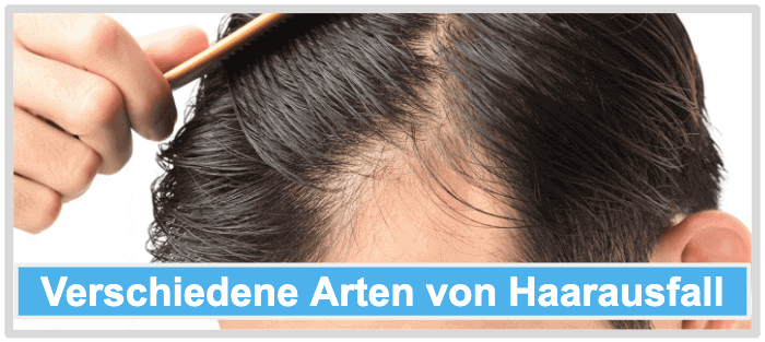 Verschiedene Arten von Haarausfall